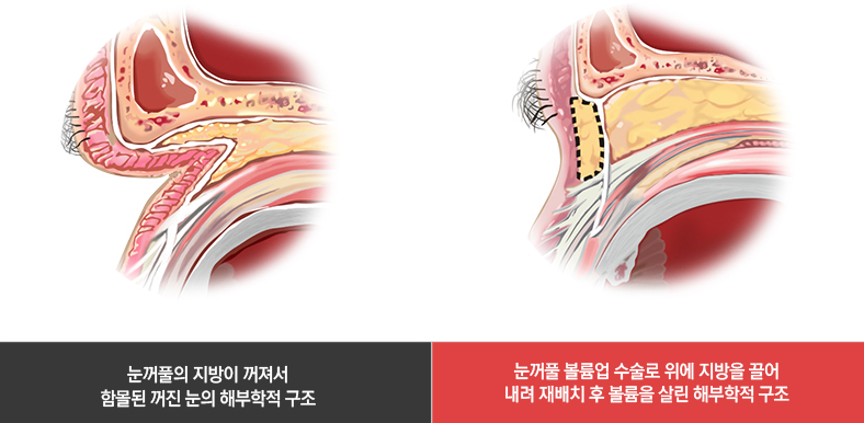 눈꺼풀 볼륨업 수술로 위에 지방을 끌어 내려 재배치 후 볼륨을 살린 해부학적 구조